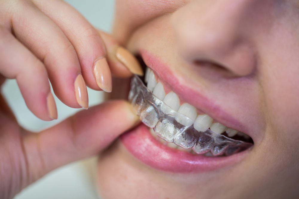 Invisalign for Kids